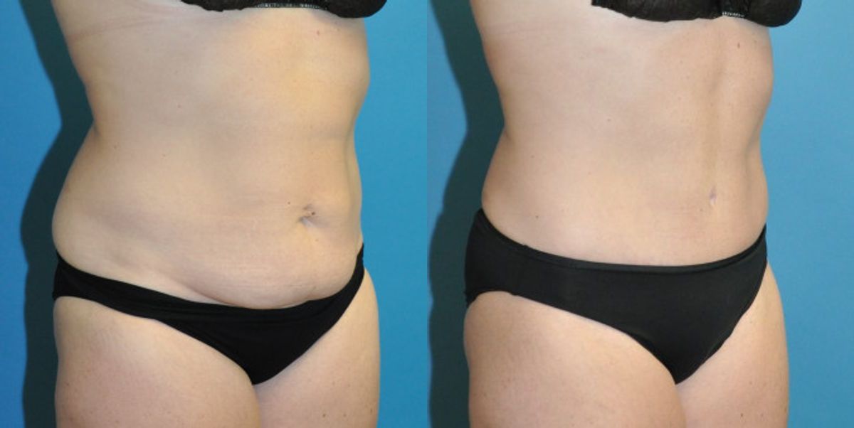 Tummy Tuck #43 - Before and After