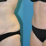 Tummy Tuck #43 - Before and After