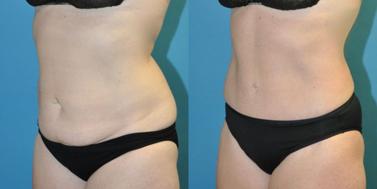 Tummy Tuck #43 - Before and After