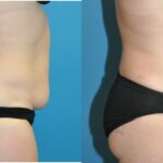 Tummy Tuck #43 - Before and After