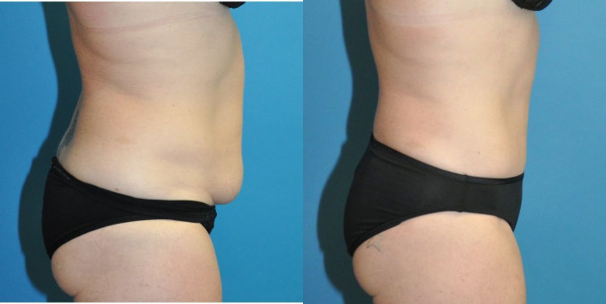 Tummy Tuck #43 - Before and After