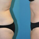 Tummy Tuck #43 - Before and After