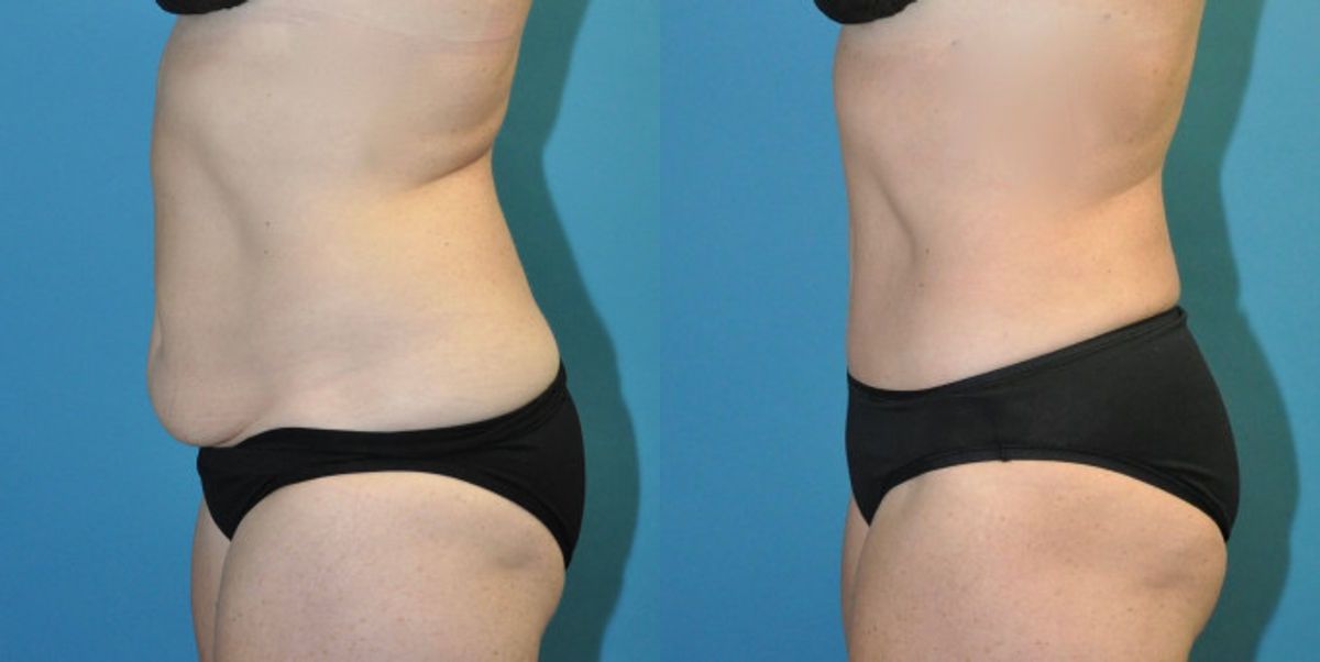 Tummy Tuck #43 - Before and After