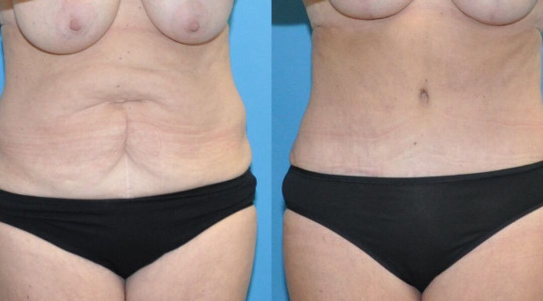 Tummy Tuck #44