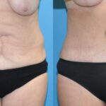 Tummy Tuck #44 - Before and After