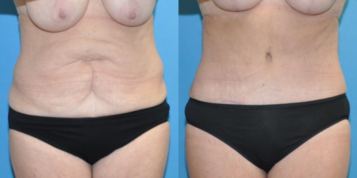 Tummy Tuck #44 - Before and After