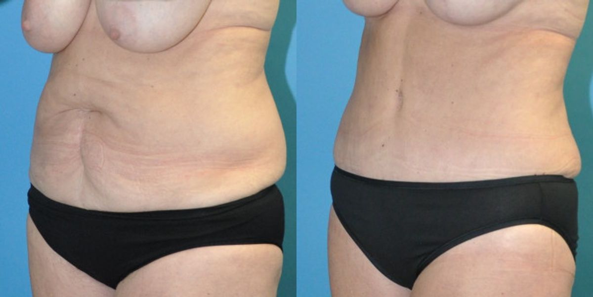 Tummy Tuck #44 - Before and After