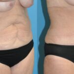 Tummy Tuck #44 - Before and After