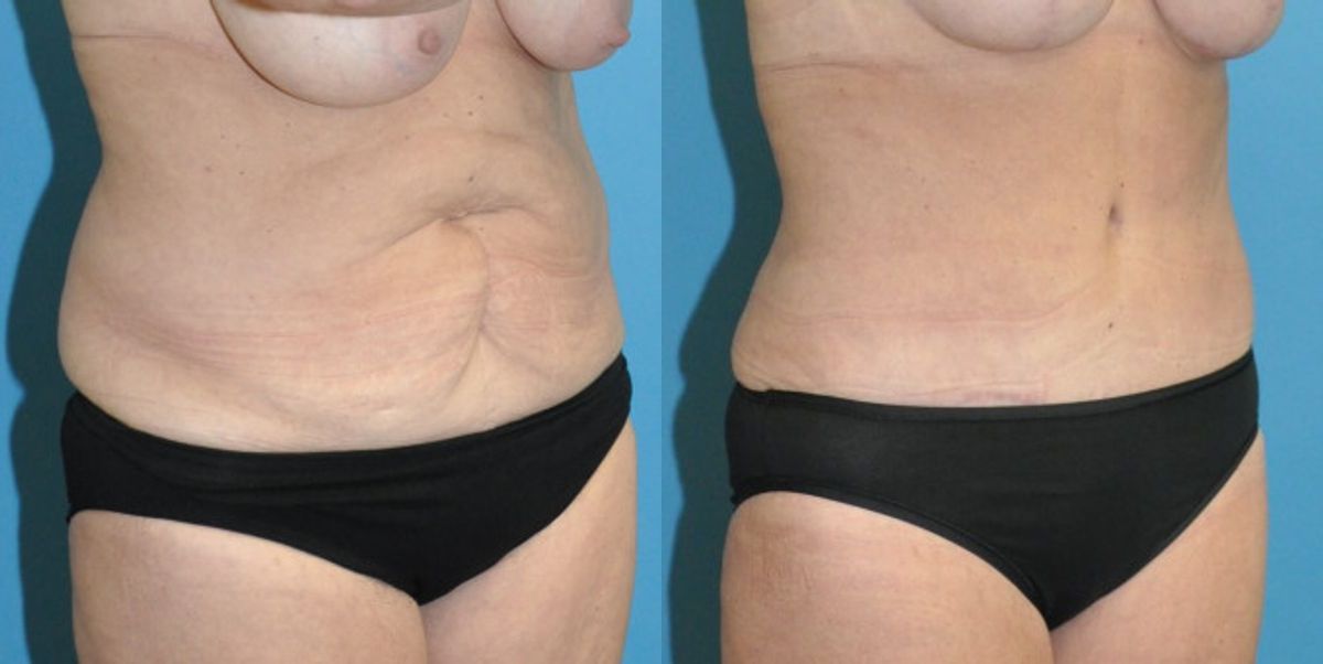 Tummy Tuck #44 - Before and After