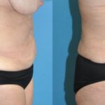 Tummy Tuck #44 - Before and After