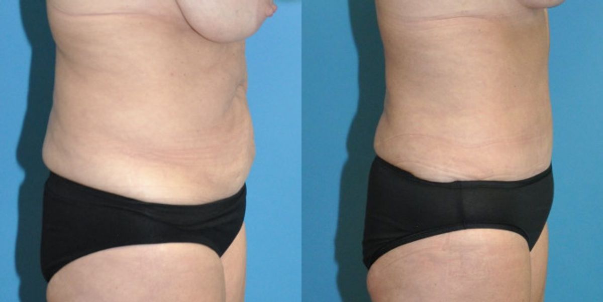 Tummy Tuck #44 - Before and After