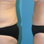 Tummy Tuck #44 - Before and After