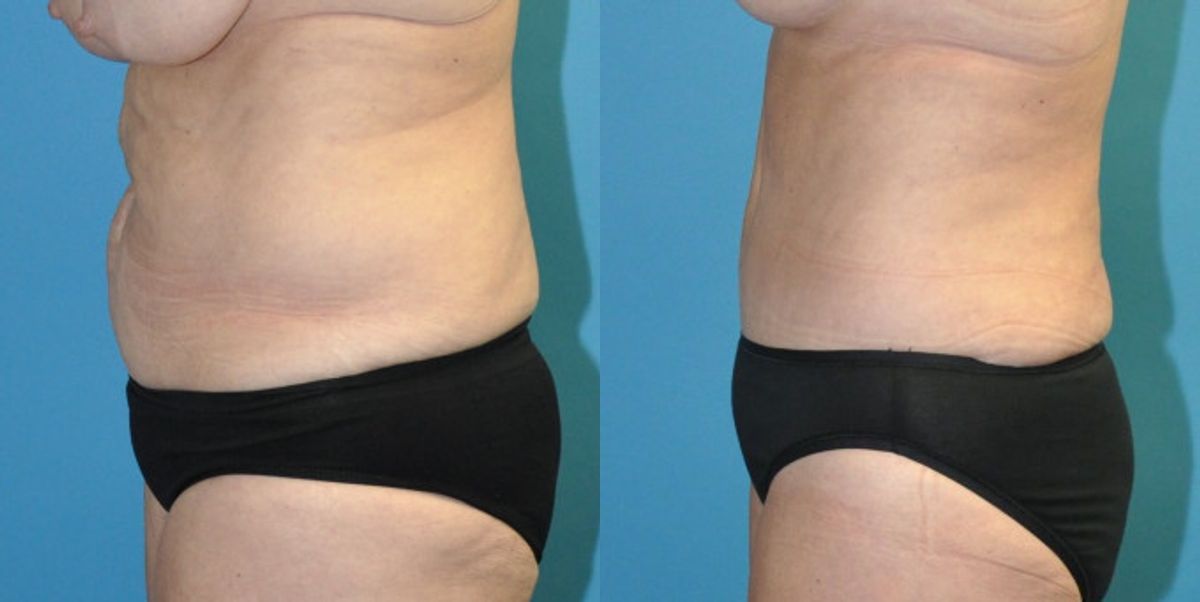 Tummy Tuck #44 - Before and After