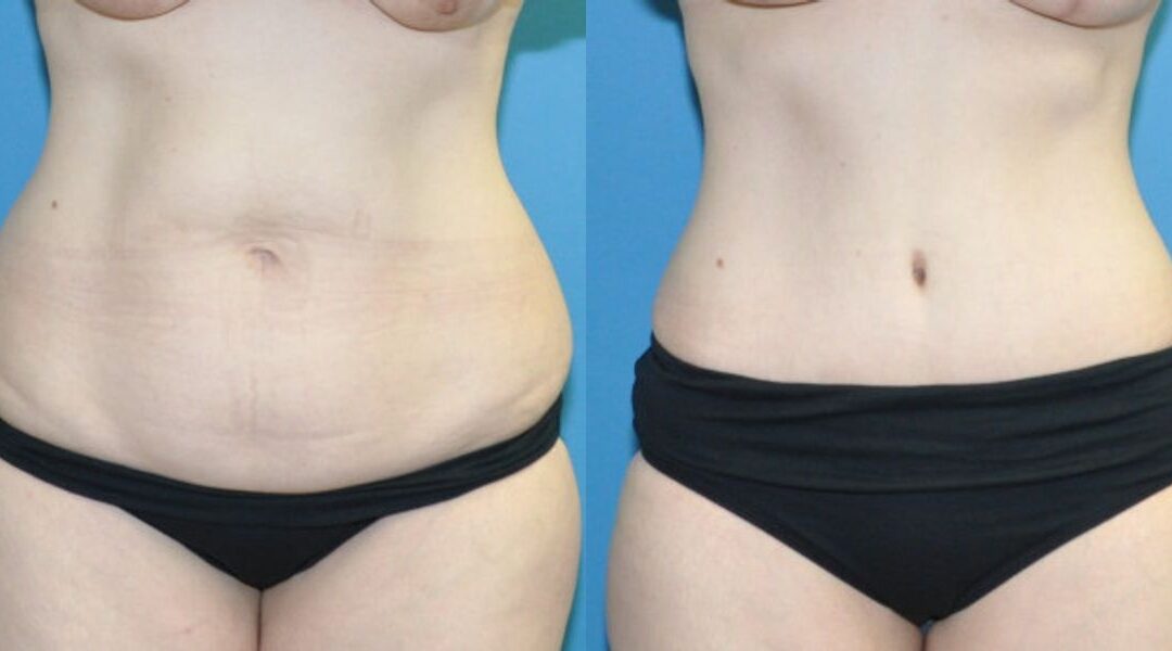 Tummy Tuck #45
