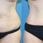 Tummy Tuck #45 - Before and After