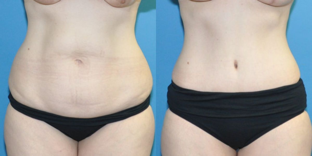 Tummy Tuck #45 - Before and After