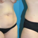 Tummy Tuck #45 - Before and After