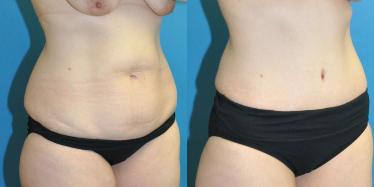 Tummy Tuck #45 - Before and After