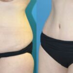 Tummy Tuck #45 - Before and After