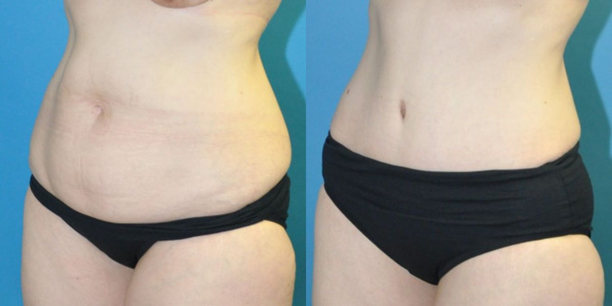 Tummy Tuck #45 - Before and After