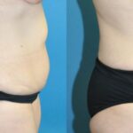 Tummy Tuck #45 - Before and After