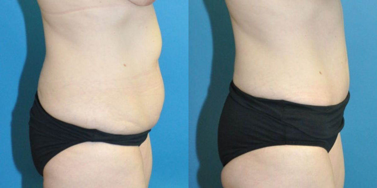 Tummy Tuck #45 - Before and After