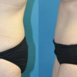 Tummy Tuck #45 - Before and After