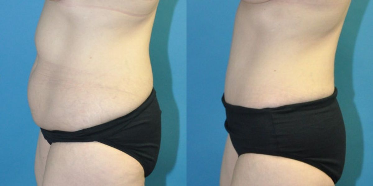 Tummy Tuck #45 - Before and After