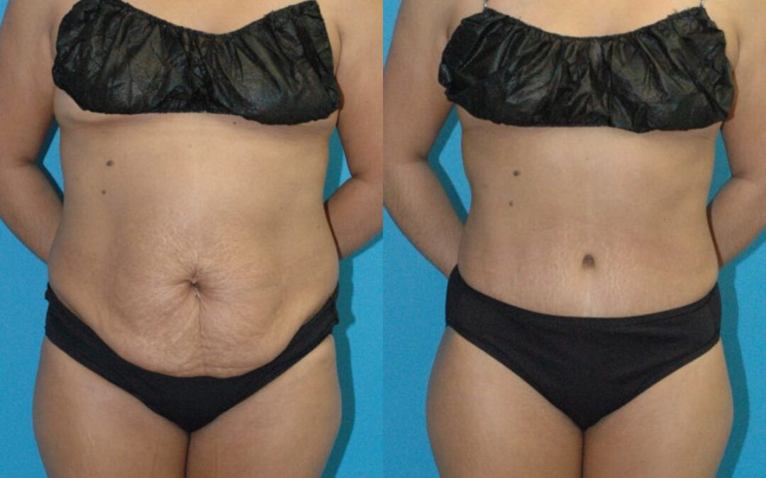 Tummy Tuck #46
