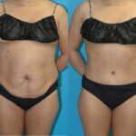 Tummy Tuck #46 - Before and After