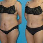 Tummy Tuck #46 - Before and After