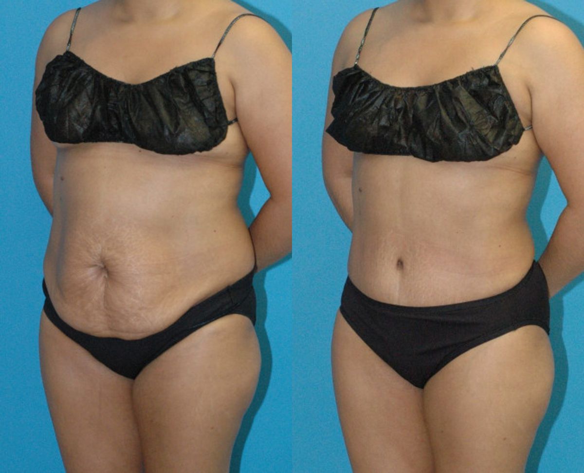 Tummy Tuck #46 - Before and After