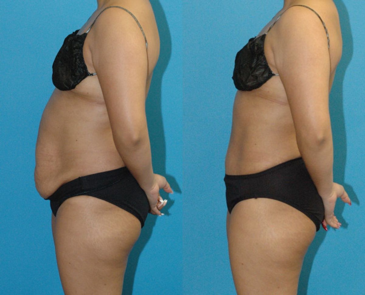 Tummy Tuck #46 - Before and After