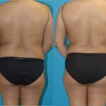 Tummy Tuck #46 - Before and After