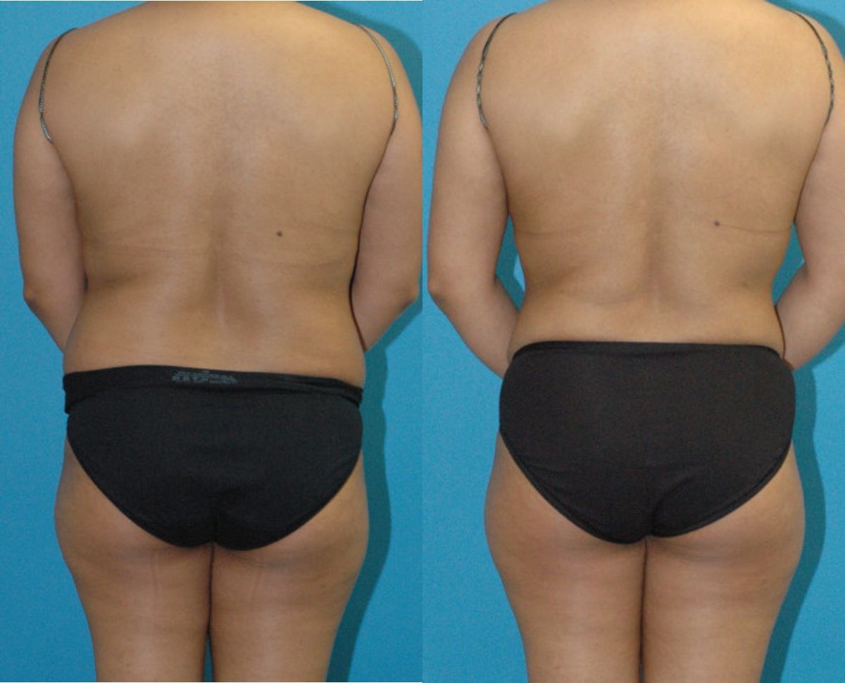 Tummy Tuck #46 - Before and After