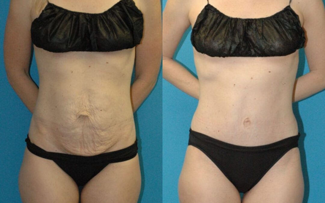 Tummy Tuck #47