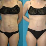 Tummy Tuck #47 - Before and After
