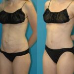 Tummy Tuck #47 - Before and After