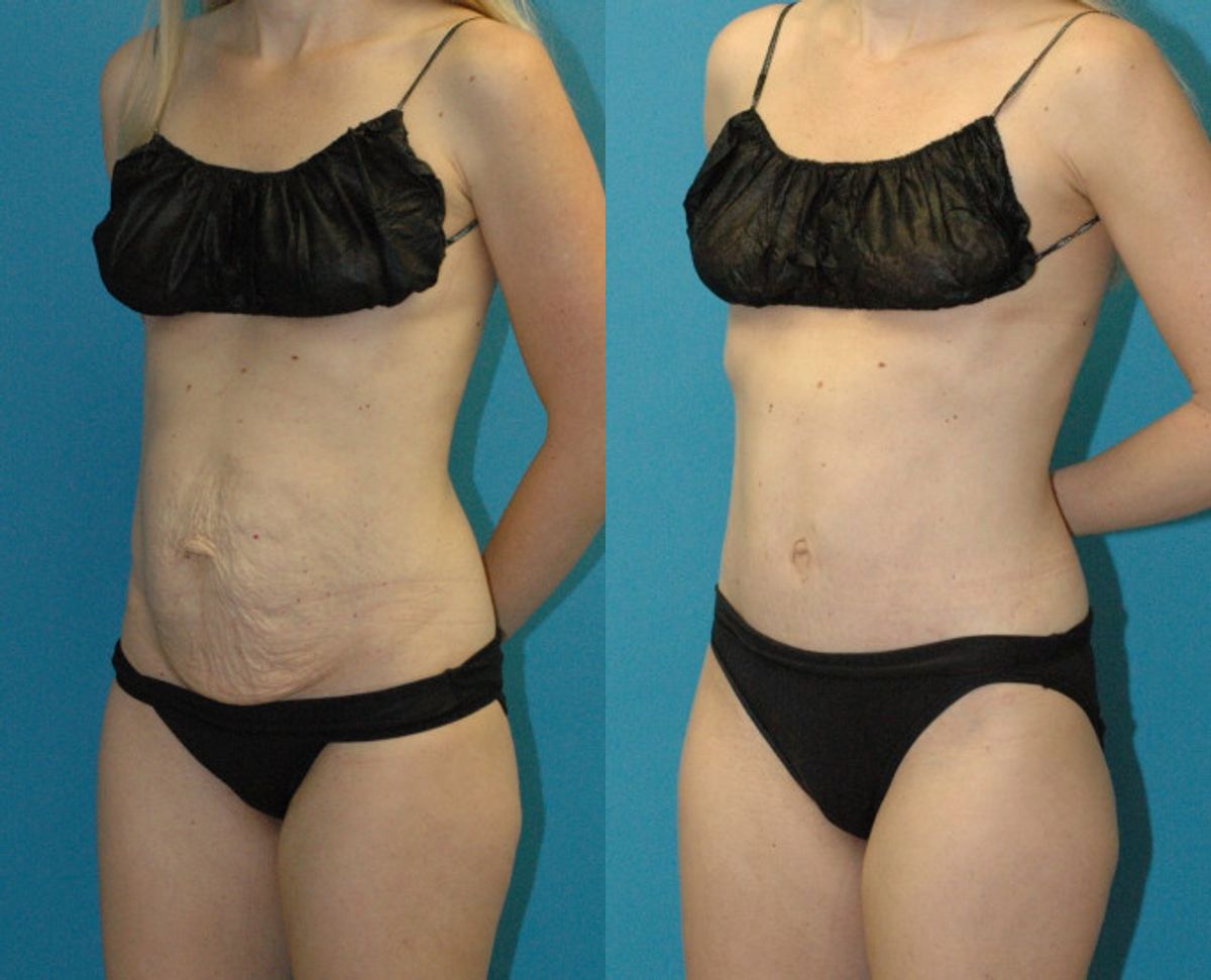 Tummy Tuck #47 - Before and After