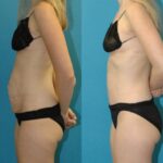 Tummy Tuck #47 - Before and After