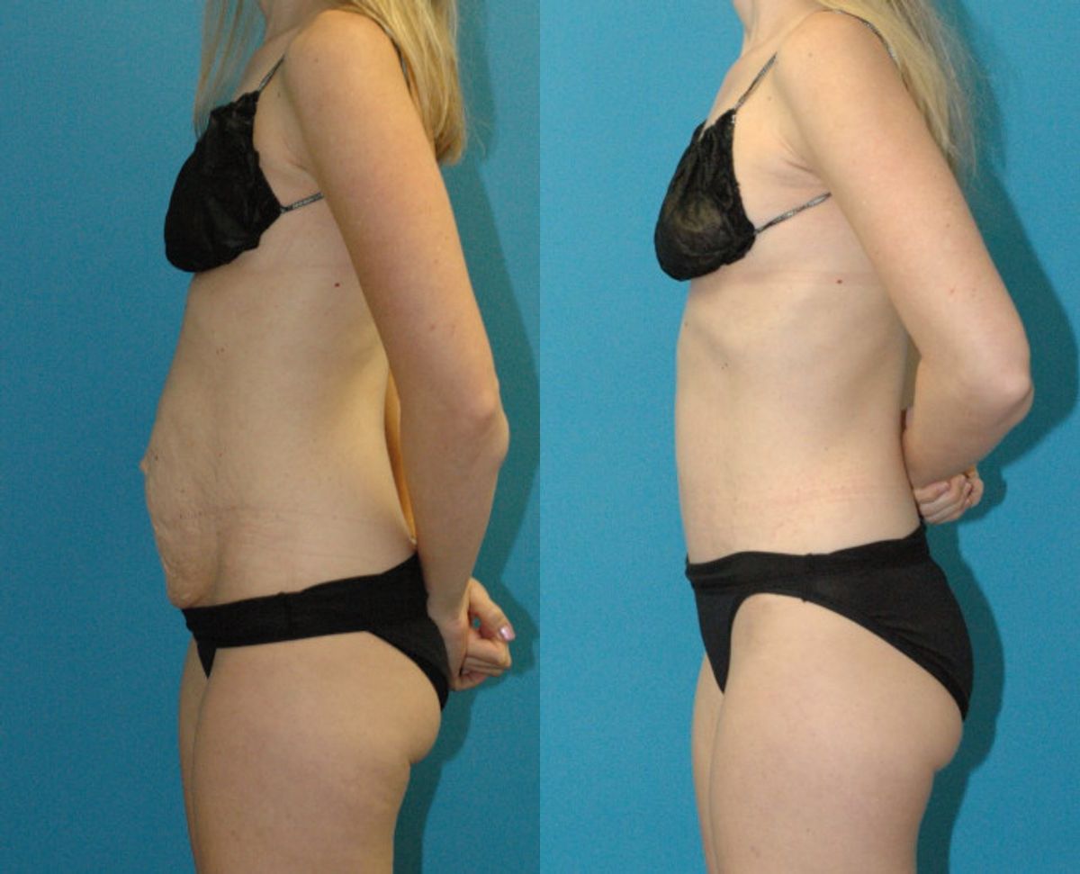 Tummy Tuck #47 - Before and After