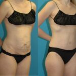 Tummy Tuck #47 - Before and After