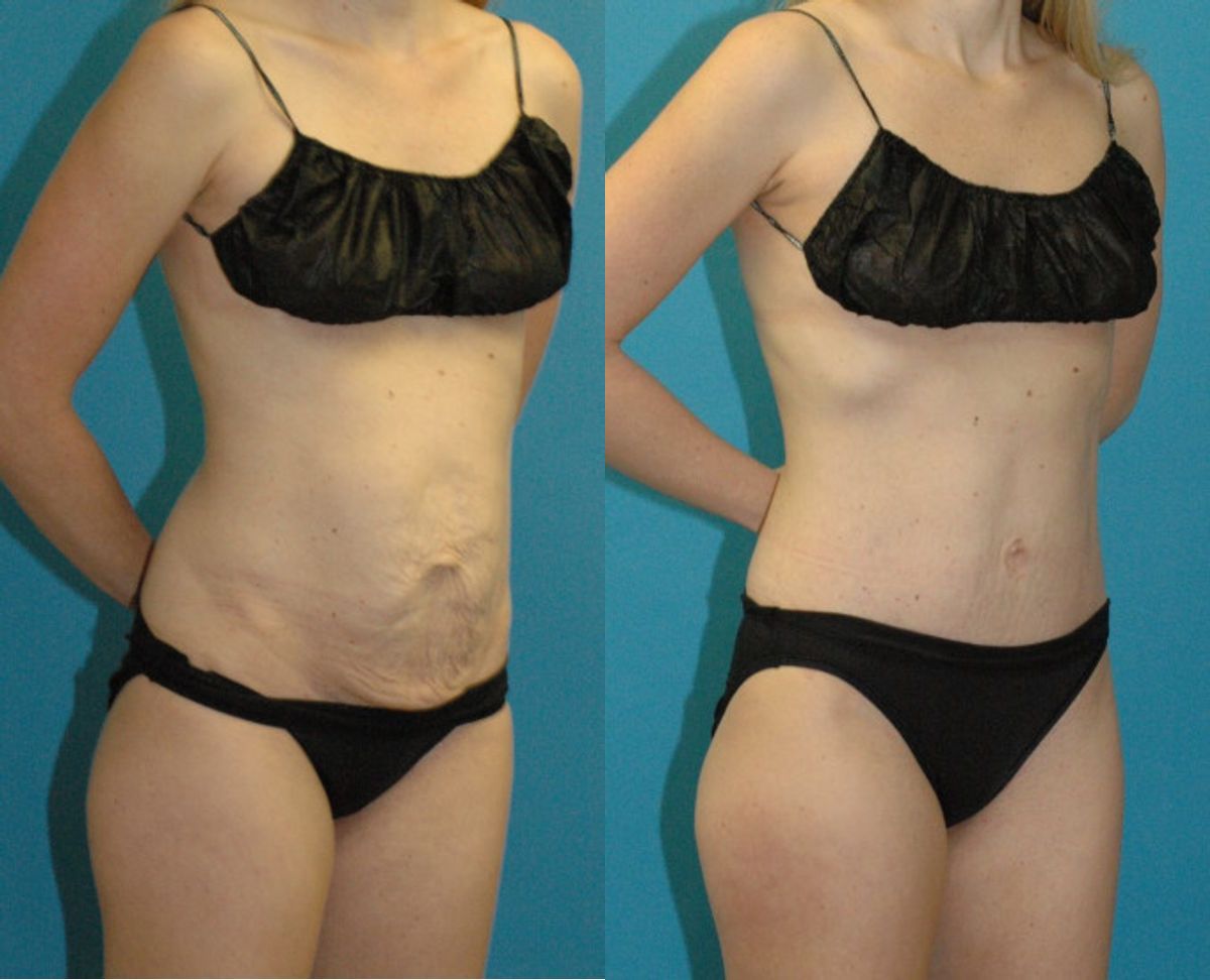 Tummy Tuck #47 - Before and After