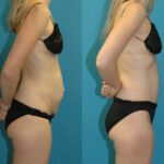 Tummy Tuck #47 - Before and After