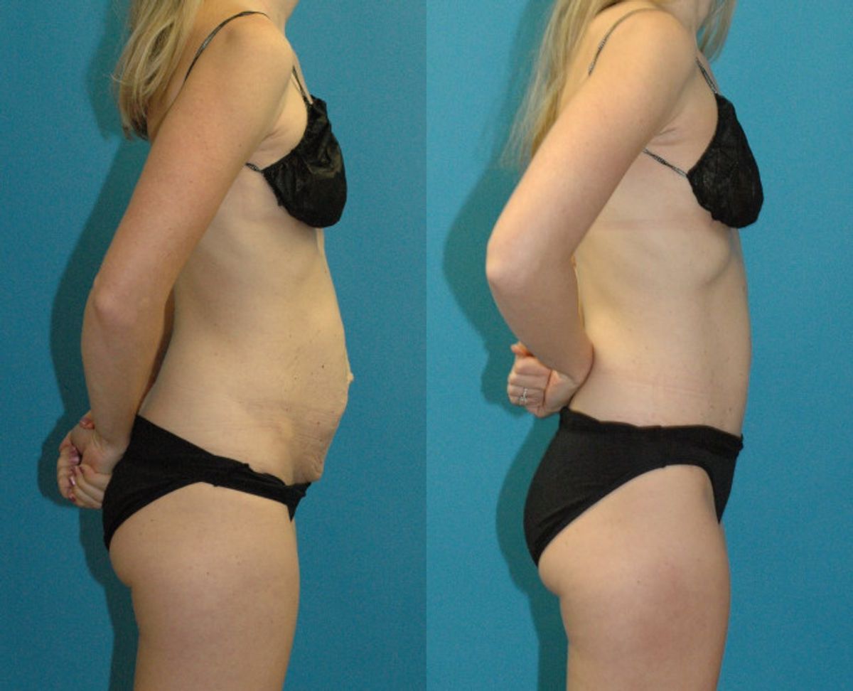 Tummy Tuck #47 - Before and After
