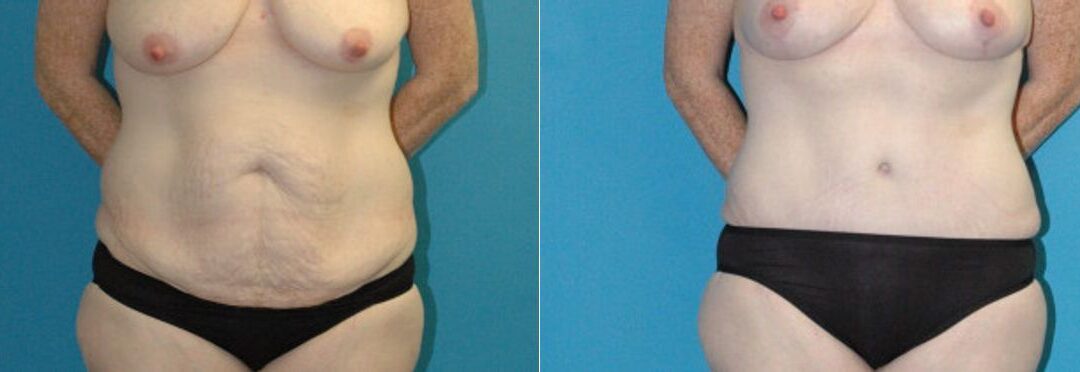 Tummy Tuck #48