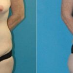 Tummy Tuck #48 - Before and After