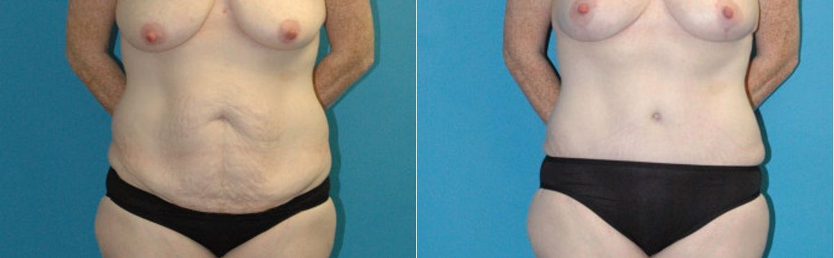 Tummy Tuck #48 - Before and After