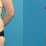 Tummy Tuck #48 - Before and After
