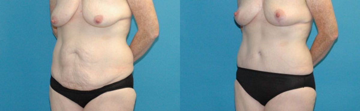Tummy Tuck #48 - Before and After